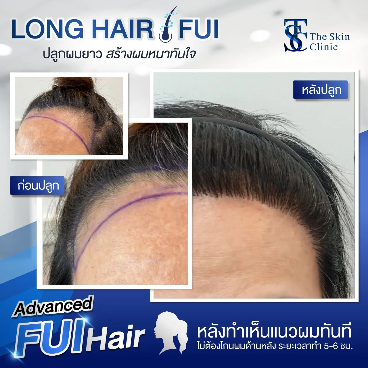 Review FUE I hair transplant with no stitching