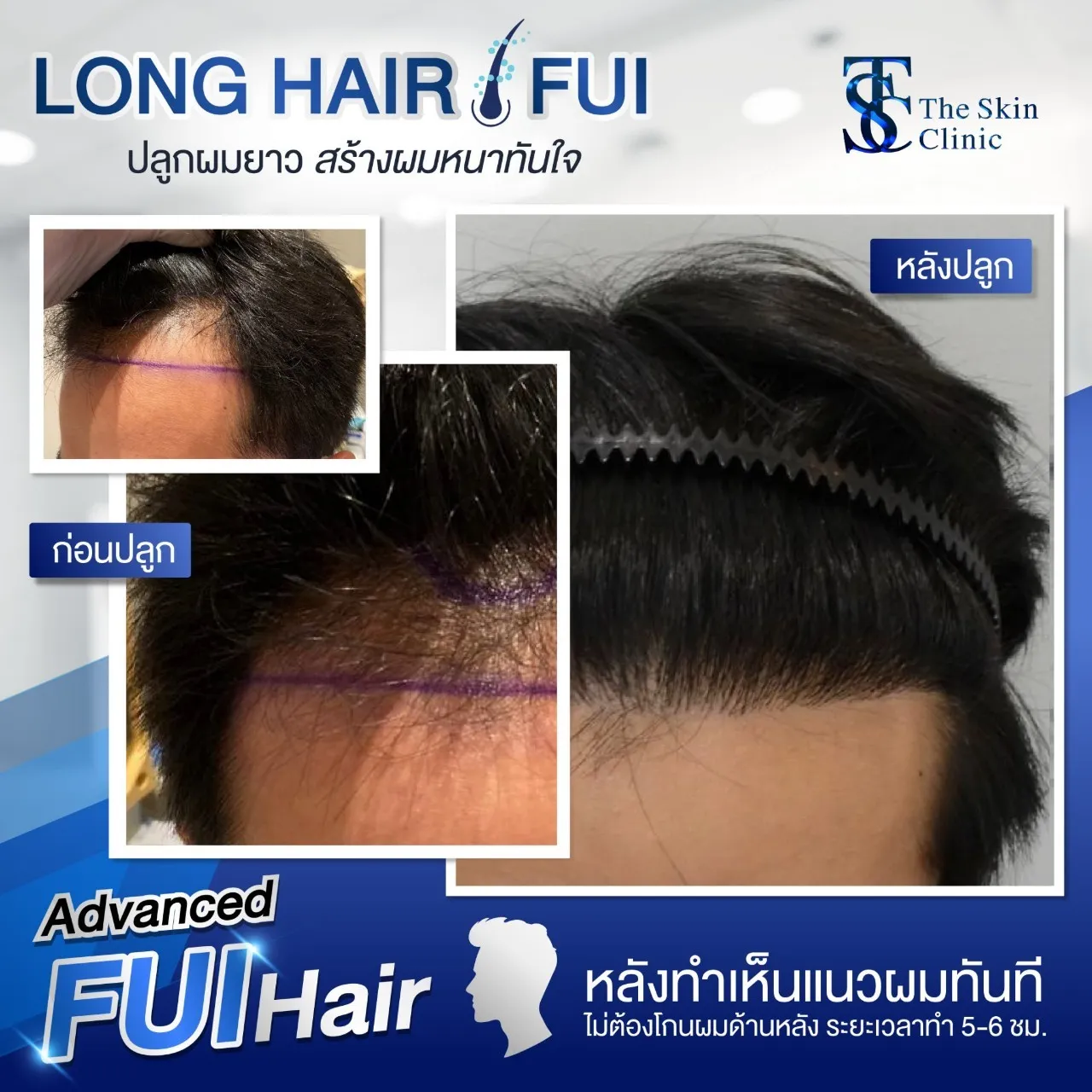 Review FUE I hair transplant with no stitching