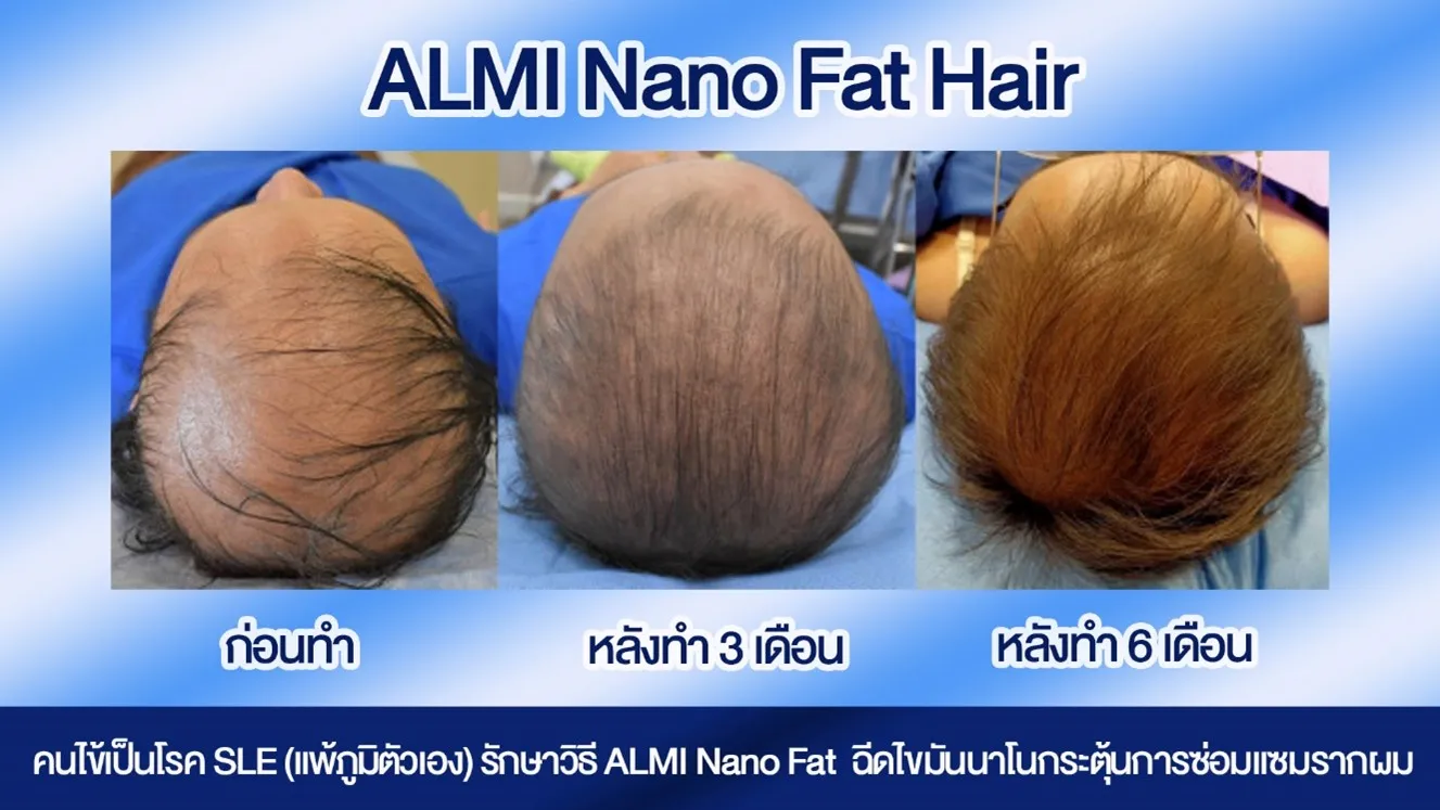 การรักษาด้วยการฉีดไขมันกระตุ้นรากผม (ALMI Nanofat for Hair Loss)