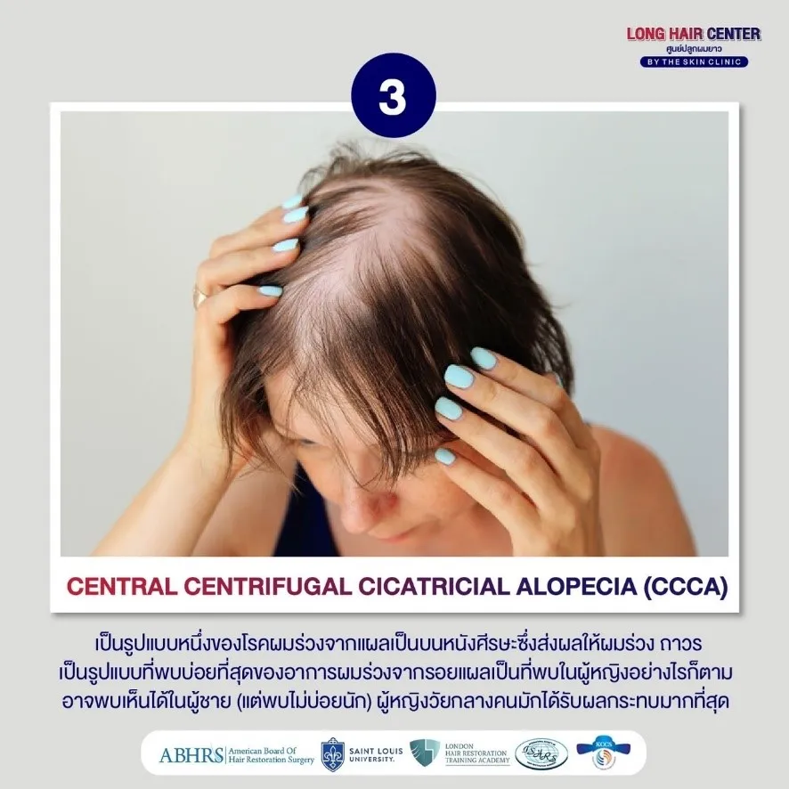 โรคผมร่วง Central Centrifugal Cicatricial Alopecia
