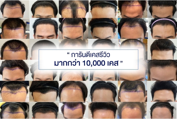 Hair Transplant Bangkok