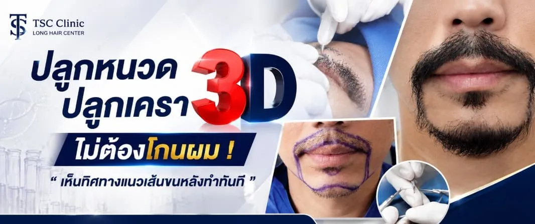 ปลูกหนวดเครา 3D Long Hair FUI ที่โรงพยาบาลปลูกผม Dr.Top Hair Hospital