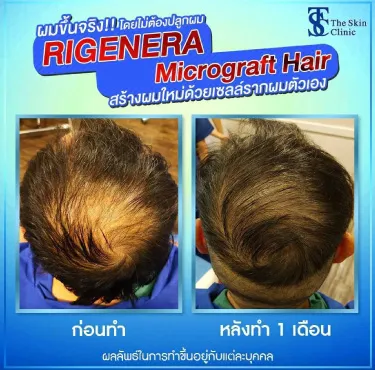 THE SKIN CLINIC | ผลลัพธ์หลังศัลยกรรมปลูกผมด้วยเทคนิค RIGENERA  Micrograft Hair
