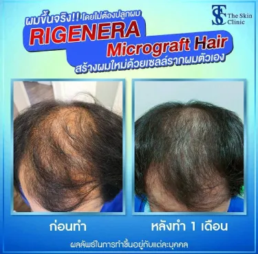 THE SKIN CLINIC | ผลลัพธ์หลังศัลยกรรมปลูกผมด้วยเทคนิค RIGENERA  Micrograft Hair