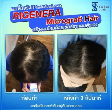 THE SKIN CLINIC | RIGENERA Micrograft Hair