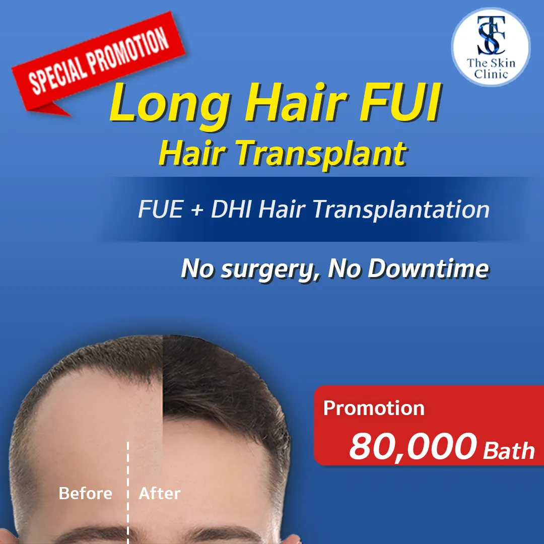 Recell Hair Transplant, FUE Hair Transplant, Hair loss | THE SKIN CLINIC