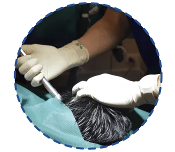 The Long Hair FUI hair transplant procedure | THE SKIN CLINIC