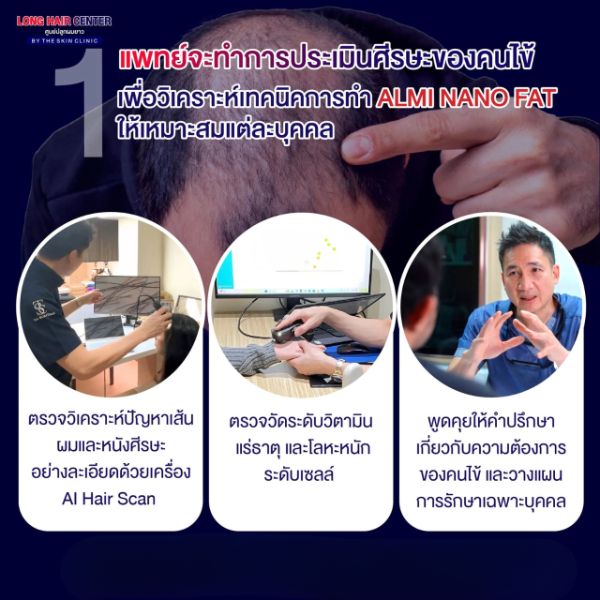 ALMI Nano fat ฟื้นฟูรากผม คลินิก ปลูกผม ทางเลือกใหม่ที่ปลอดภัย ไม่ต้องปลูกผม