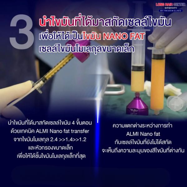 ALMI Nano fat ฟื้นฟูรากผม คลินิก ปลูกผม ทางเลือกใหม่ที่ปลอดภัย ไม่ต้องปลูกผม