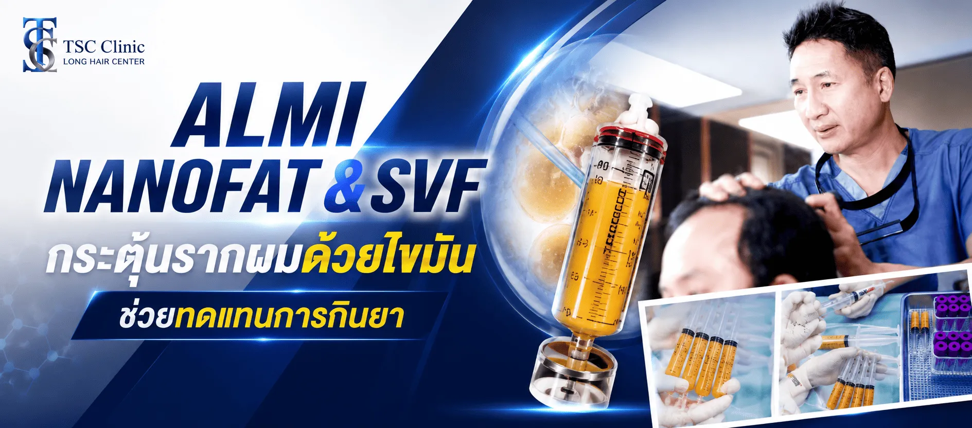 ALMI Nano fat ฟื้นฟูรากผม คลินิก ปลูกผม ทางเลือกใหม่ที่ปลอดภัย ไม่ต้องปลูกผม