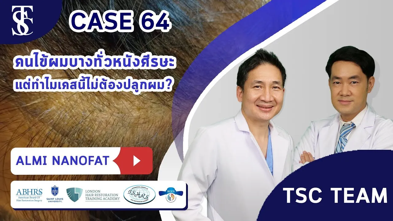 คนไข้ผมบางทั่วหนังศีรษะ แต่ทำไมเคสนี้ไม่ต้องปลูกผม? [ALMI Nano Fat]