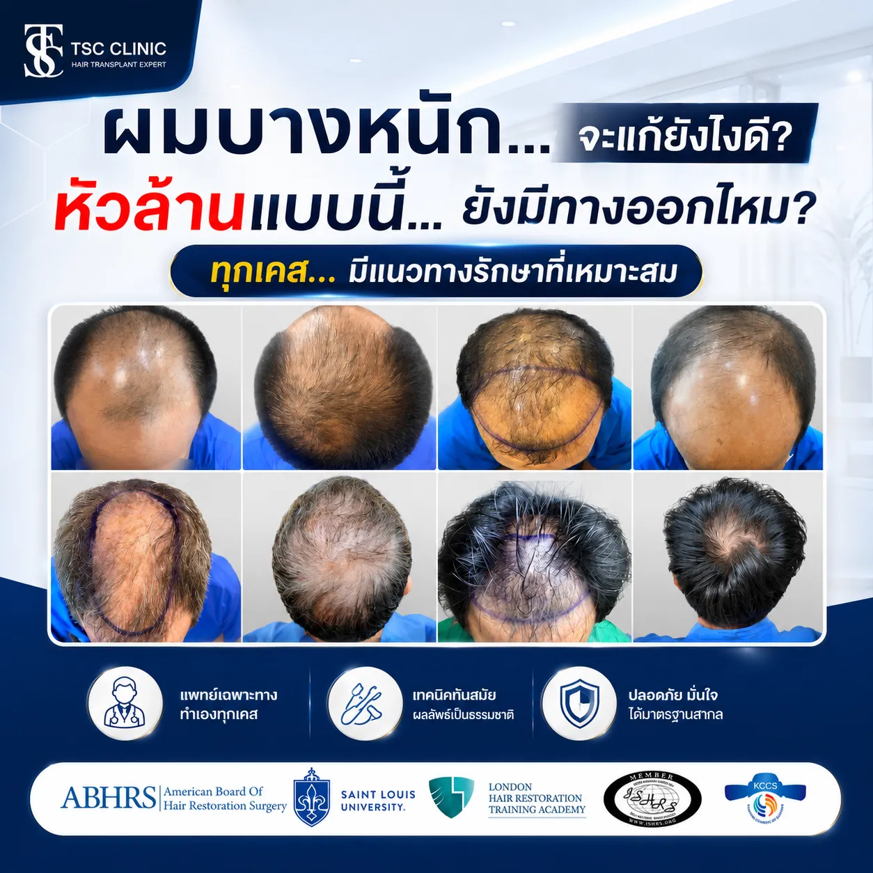 ปลูกผม Long Hair FUI เหมาะกับใคร?