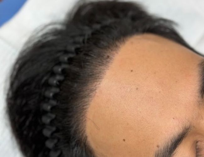 ปลูกผม DHI (DHI Hair Transplant)เทคนิคปลูกผมในโรงพยาบาล ปลูกผม ด้วย Implanter