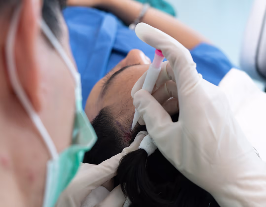 ปักกราฟต์ผมด้วย Implanter Pen