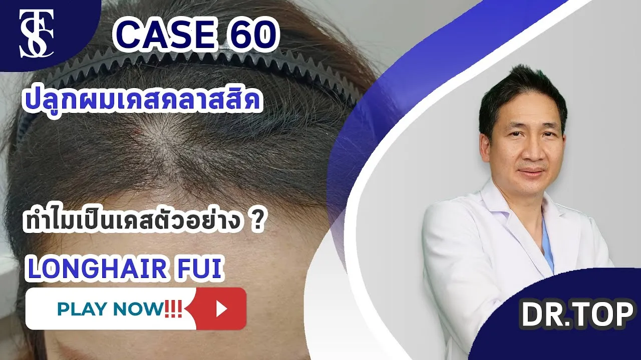 รีวิวคนไข้ ปลูกผมผู้หญิงบริเวณหน้าผาก