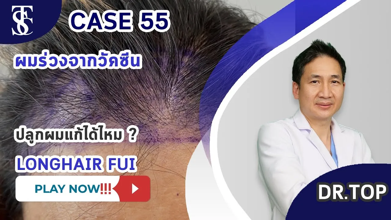 คนไข้ผมร่วงหนักมากจากการฉีดวัคซีน รักษาด้วยการปลูกผมได้ไหม?