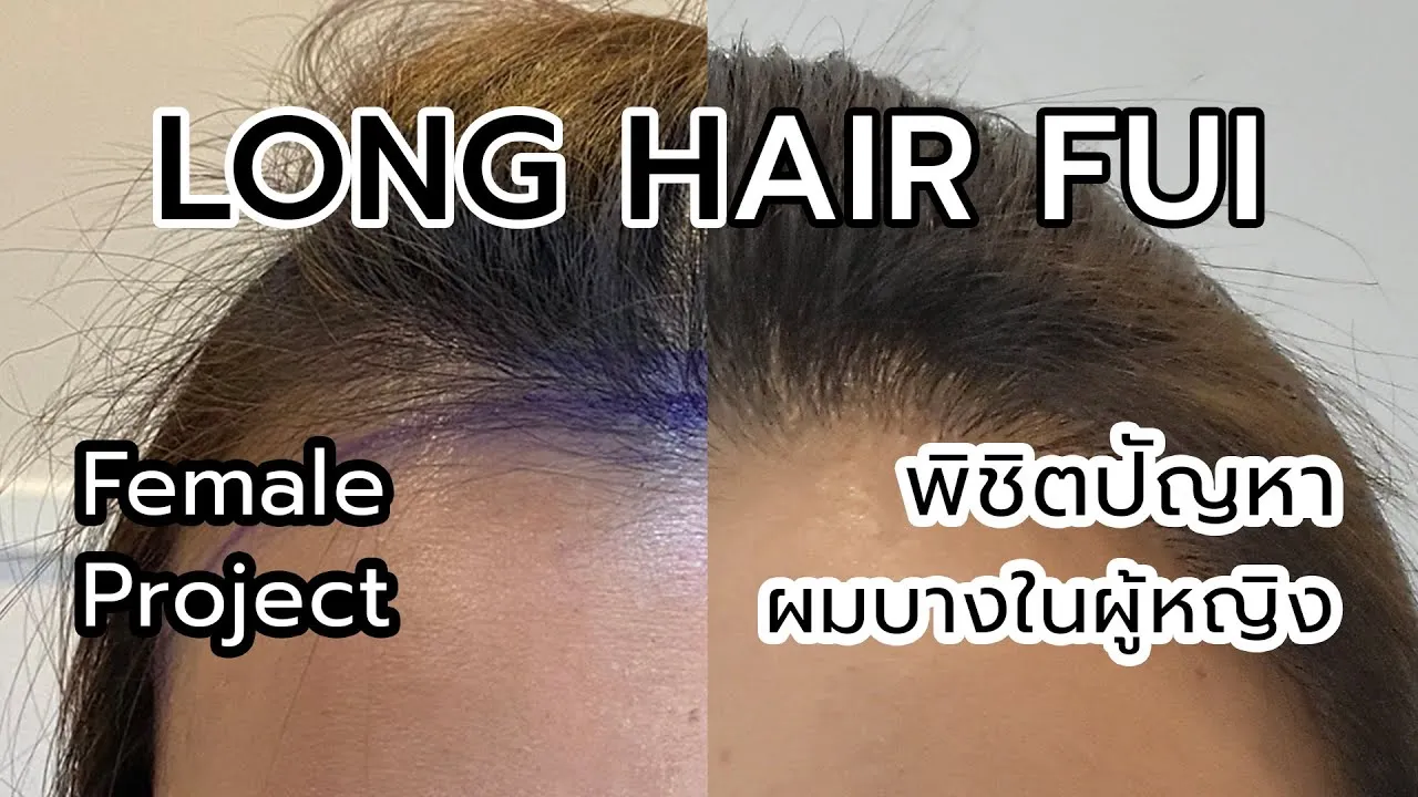 ปลูกผมผู้หญิง เทคนิค Long Hair FUE – สวยมั่นใจ ไม่ต้องโกนผม
