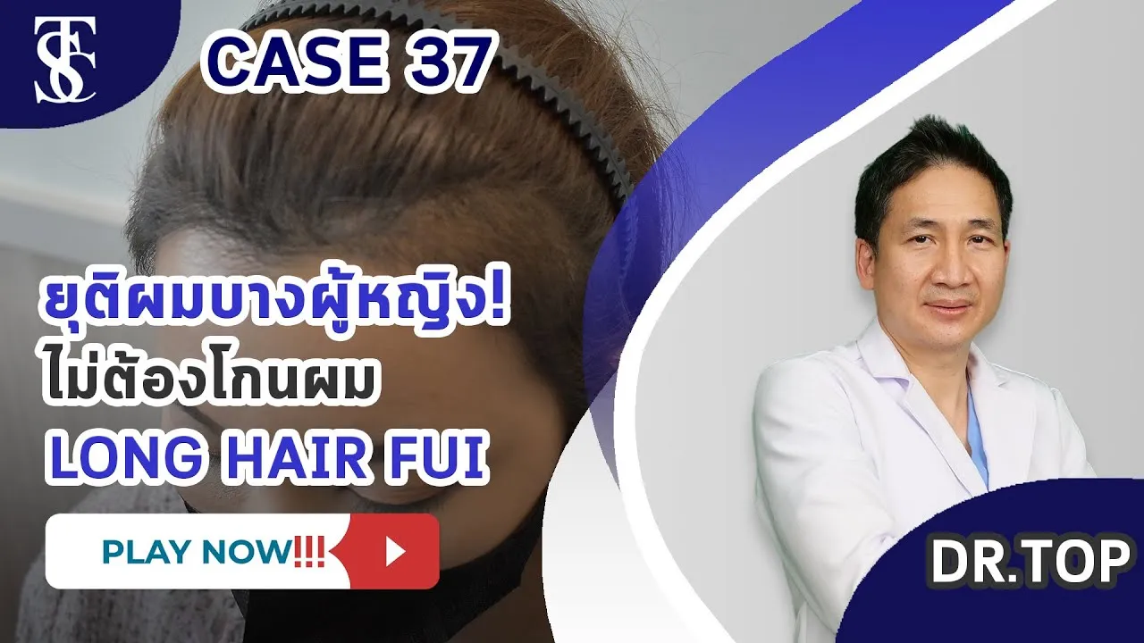 ปลูกผมผู้หญิง เทคนิค Long Hair FUE – สวยมั่นใจ ไม่ต้องโกนผม