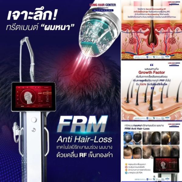 FRM Anti Hair Loss กระตุ้นรากผมด้วย Microneedle