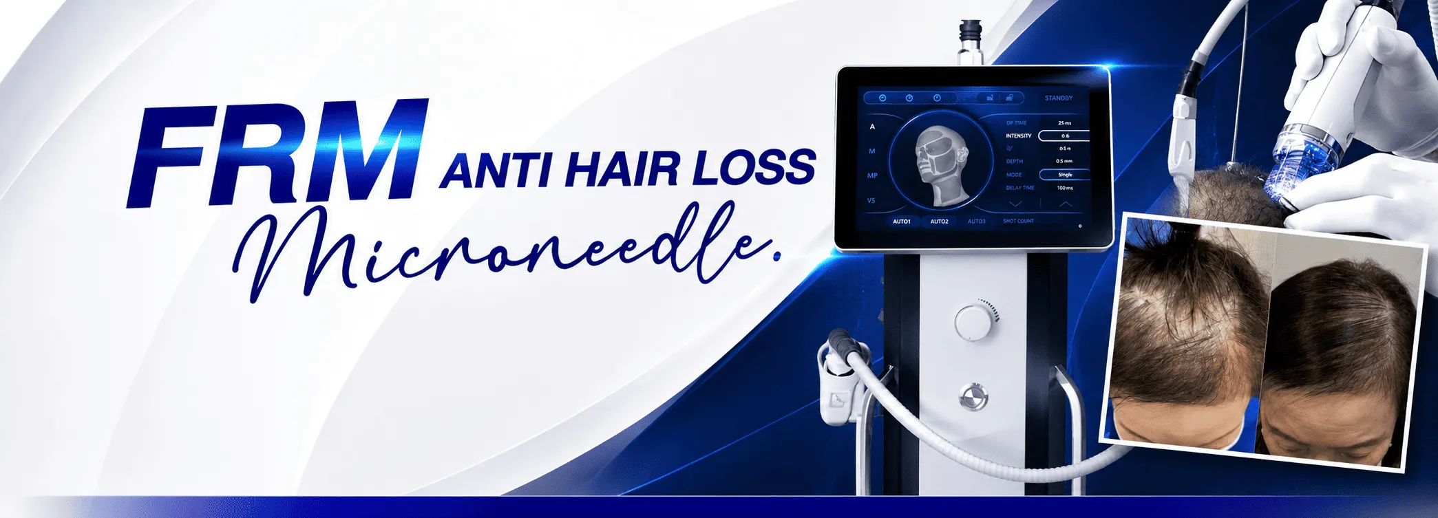 FRM Anti Hair Loss กระตุ้นรากผมด้วย Microneedle
