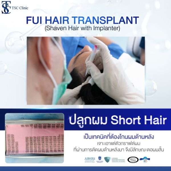 ปลูกผม FUE แบบโกนผมสั้น | THE SKIN CLINIC