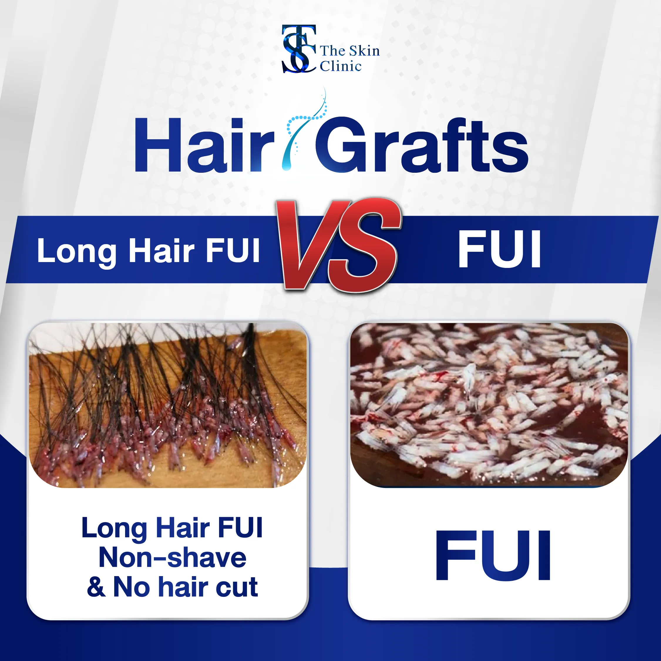 What is the FUI hair transplant technique?