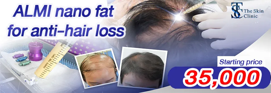 THE SKIN CLINIC | ALMI Nano Fat Transfer. Stimulate your hair root with your own fat (Nano Fat)