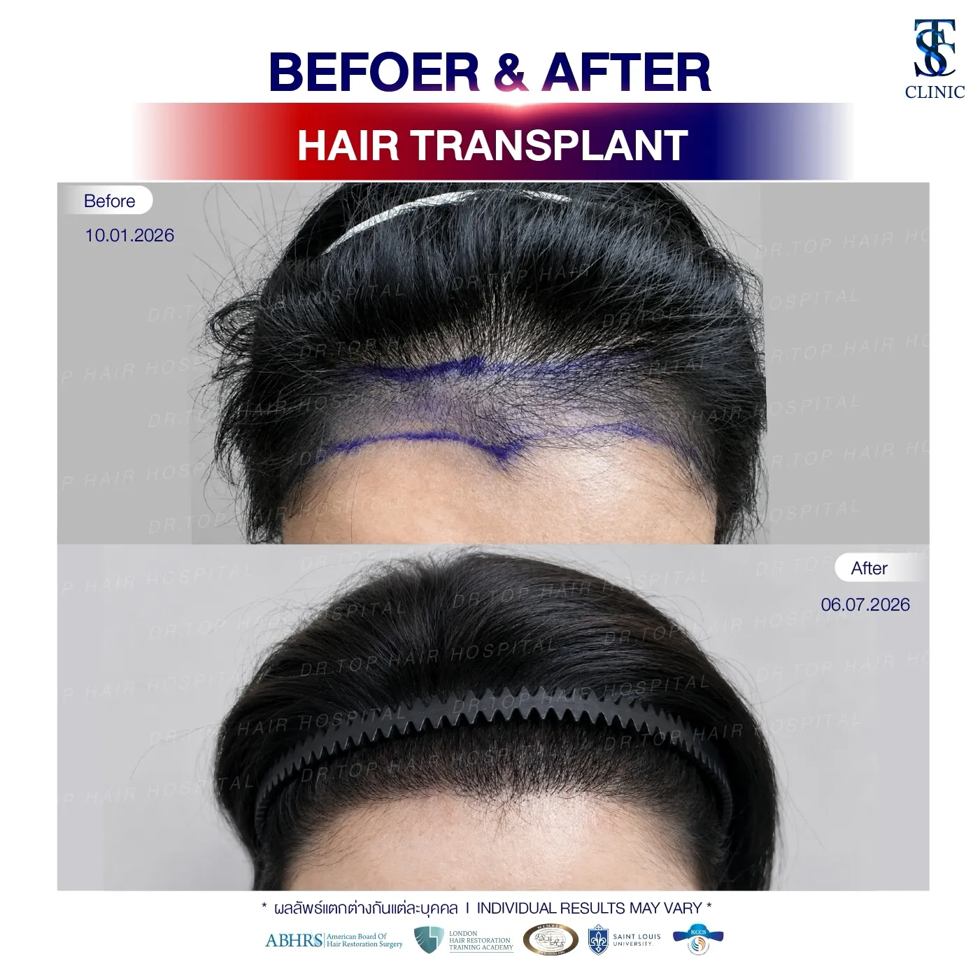 คลินิกปลูกผมถาวร ปลูกผม FUE ไร้รอยแผลเป็น | THE SKIN CLINIC