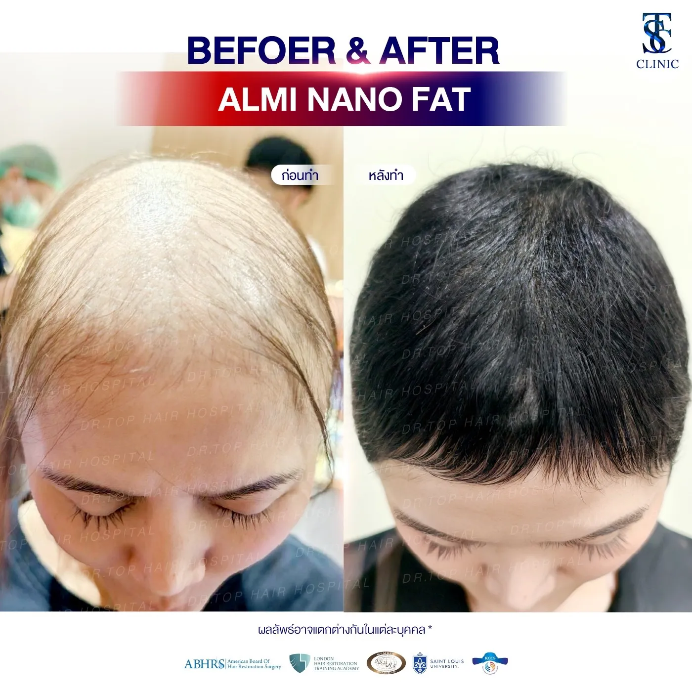 คลินิกปลูกผมถาวร ปลูกผม FUE ไร้รอยแผลเป็น | THE SKIN CLINIC