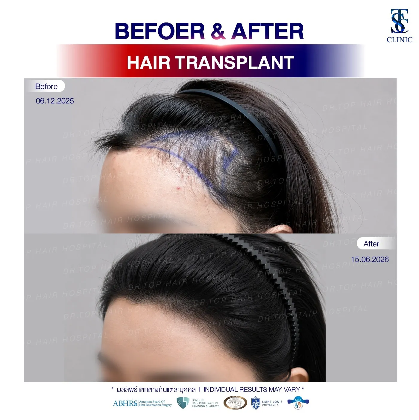 คลินิกปลูกผมถาวร ปลูกผม FUE ไร้รอยแผลเป็น | THE SKIN CLINIC