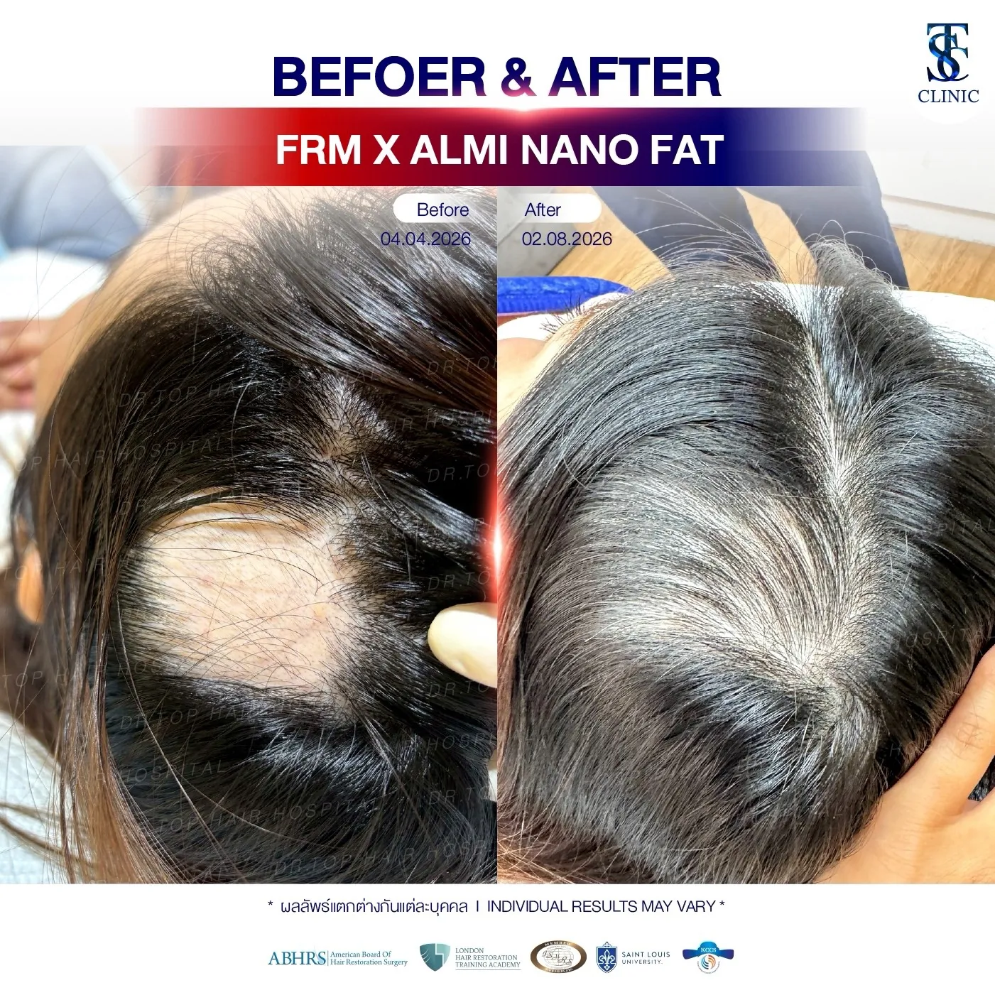 คลินิกปลูกผมถาวร ปลูกผม FUE ไร้รอยแผลเป็น | THE SKIN CLINIC