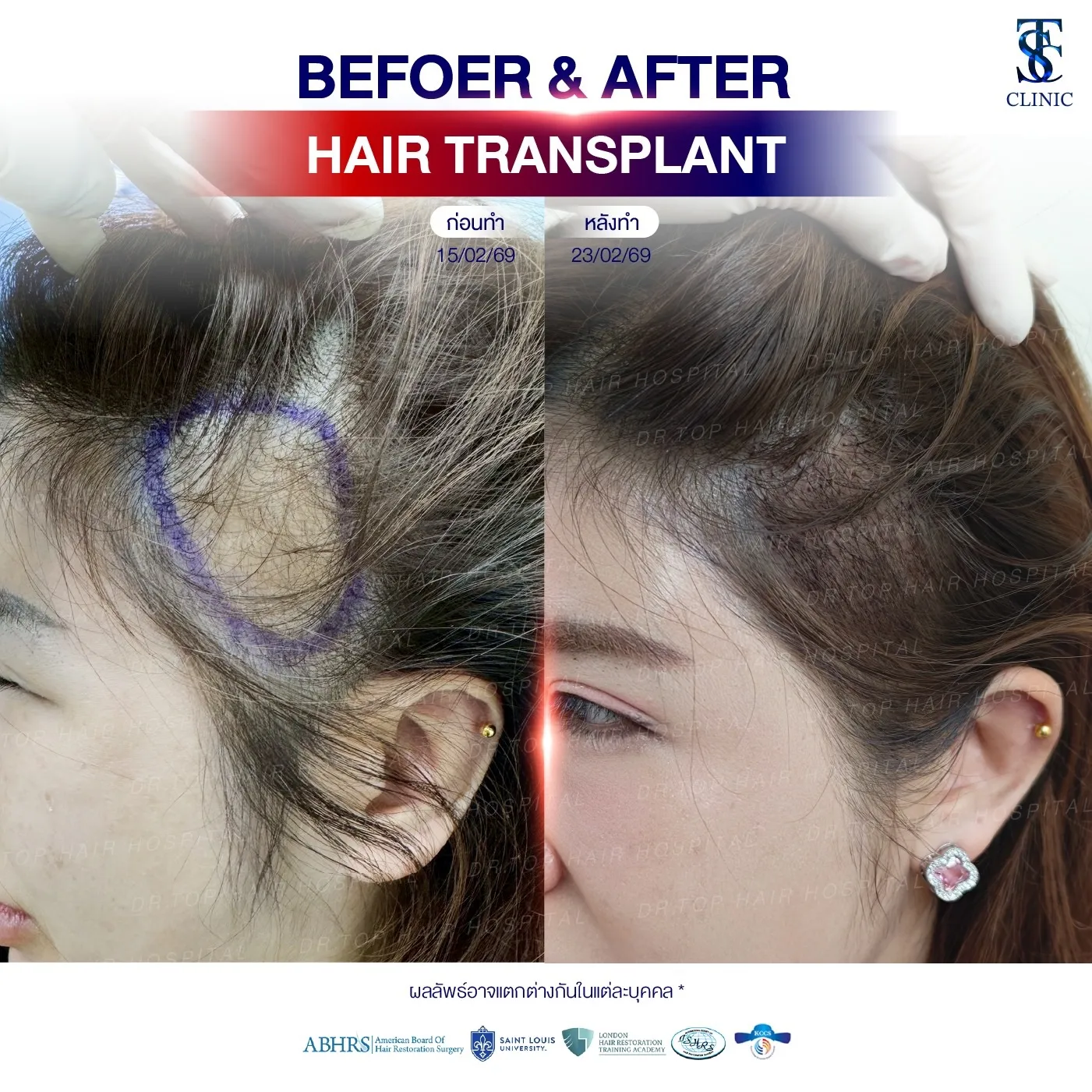 คลินิกปลูกผมถาวร ปลูกผม FUE ไร้รอยแผลเป็น | THE SKIN CLINIC