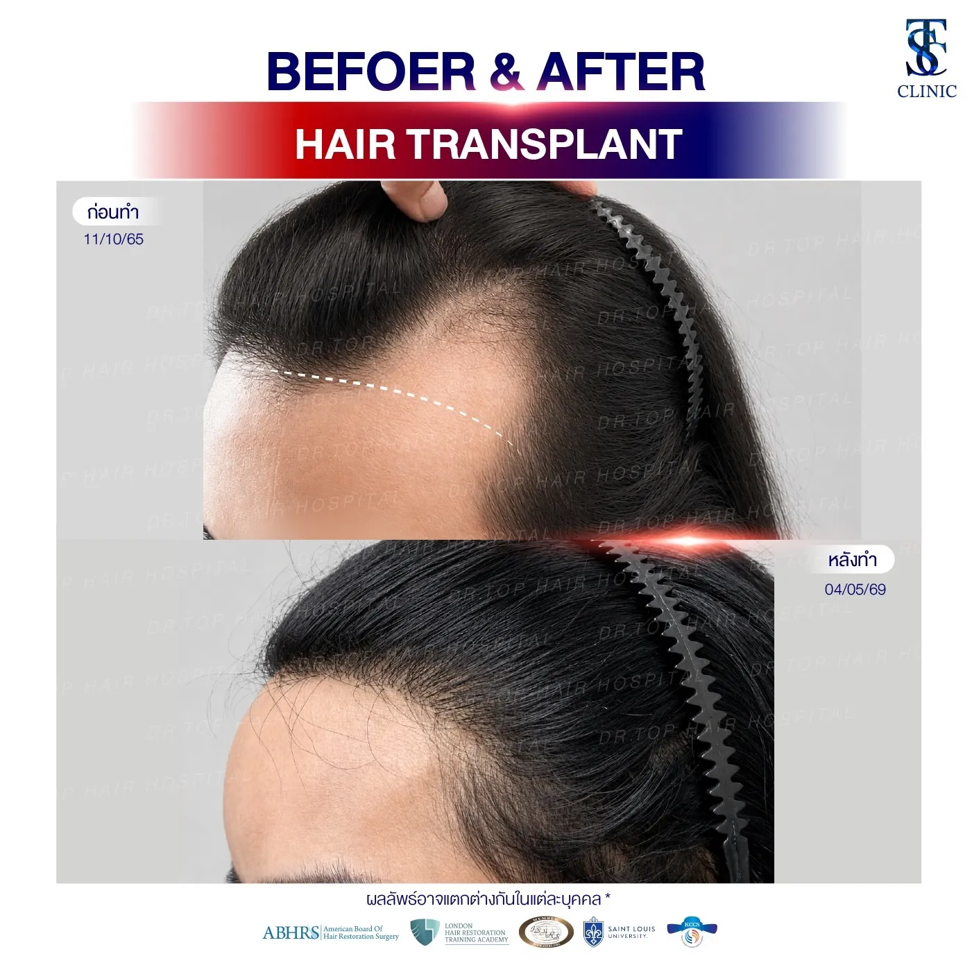 คลินิกปลูกผมถาวร ปลูกผม FUE ไร้รอยแผลเป็น | THE SKIN CLINIC