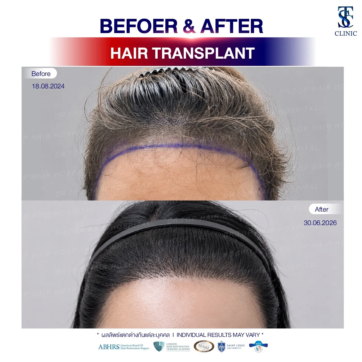 คลินิกปลูกผมถาวร ปลูกผม FUE ไร้รอยแผลเป็น | THE SKIN CLINIC