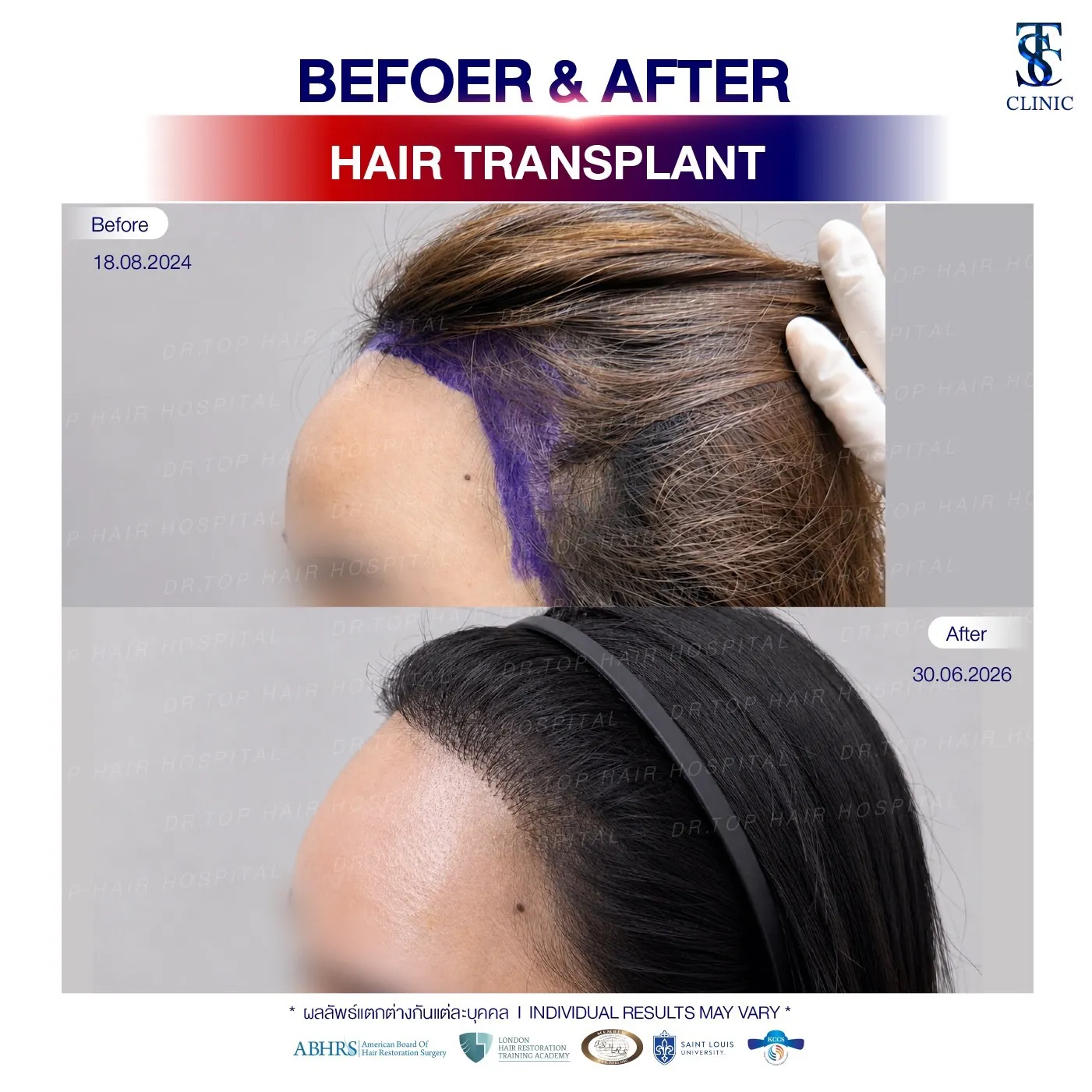 คลินิกปลูกผมถาวร ปลูกผม FUE ไร้รอยแผลเป็น | THE SKIN CLINIC