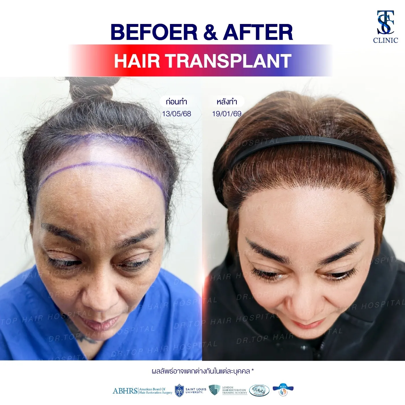 คลินิกปลูกผมถาวร ปลูกผม FUE ไร้รอยแผลเป็น | THE SKIN CLINIC