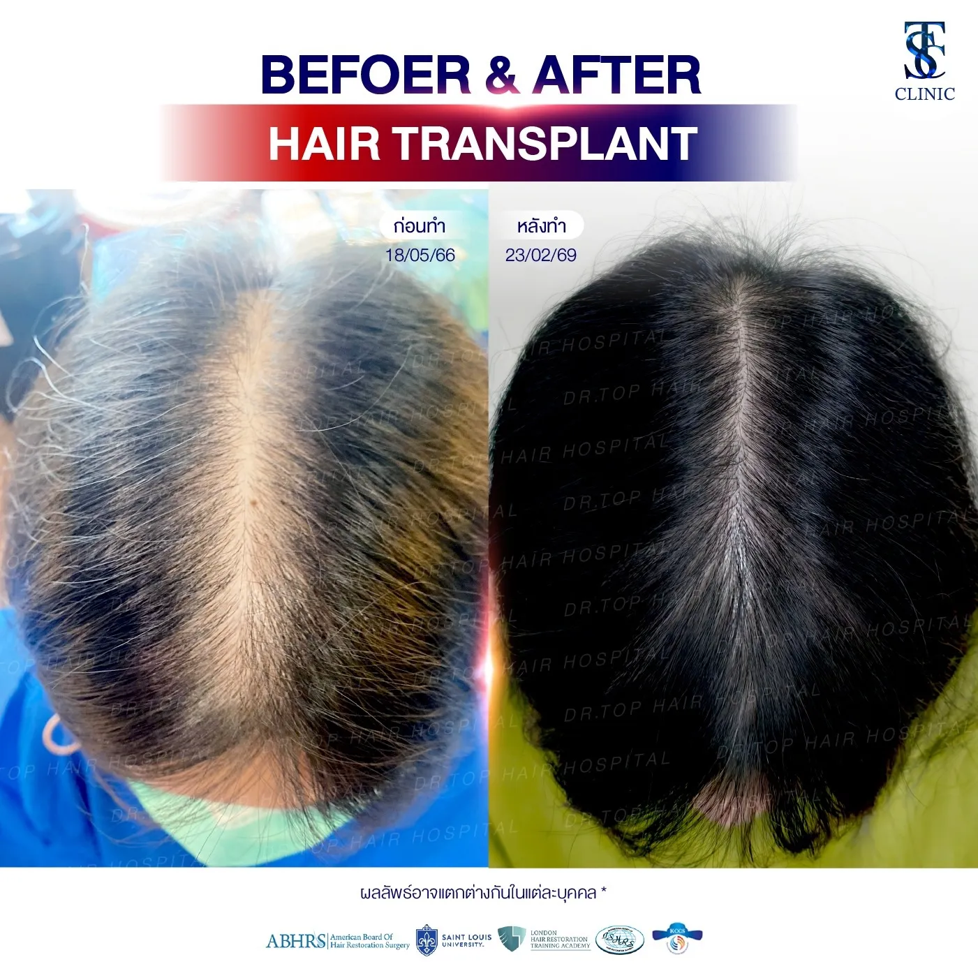 คลินิกปลูกผมถาวร ปลูกผม FUE ไร้รอยแผลเป็น | THE SKIN CLINIC