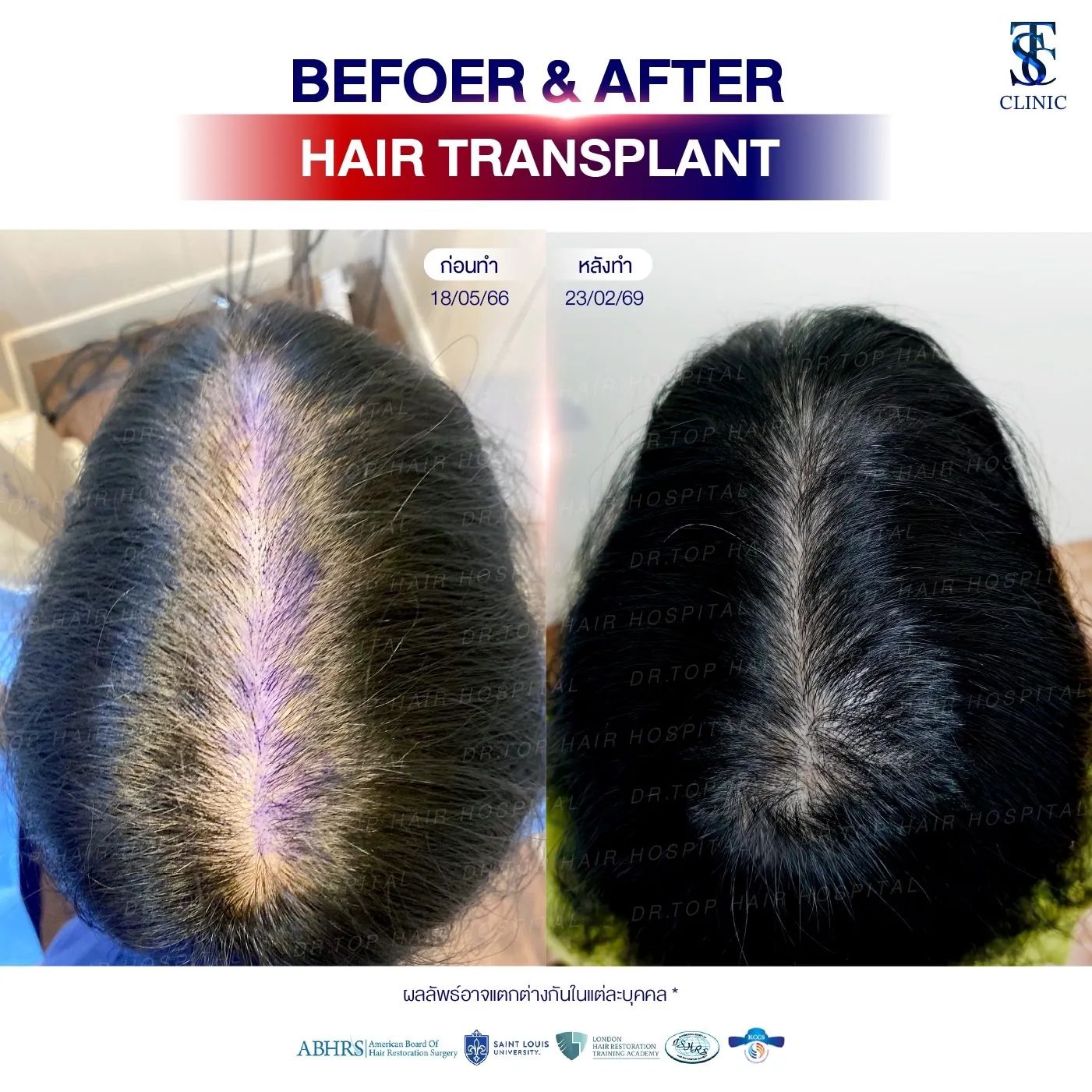 คลินิกปลูกผมถาวร ปลูกผม FUE ไร้รอยแผลเป็น | THE SKIN CLINIC