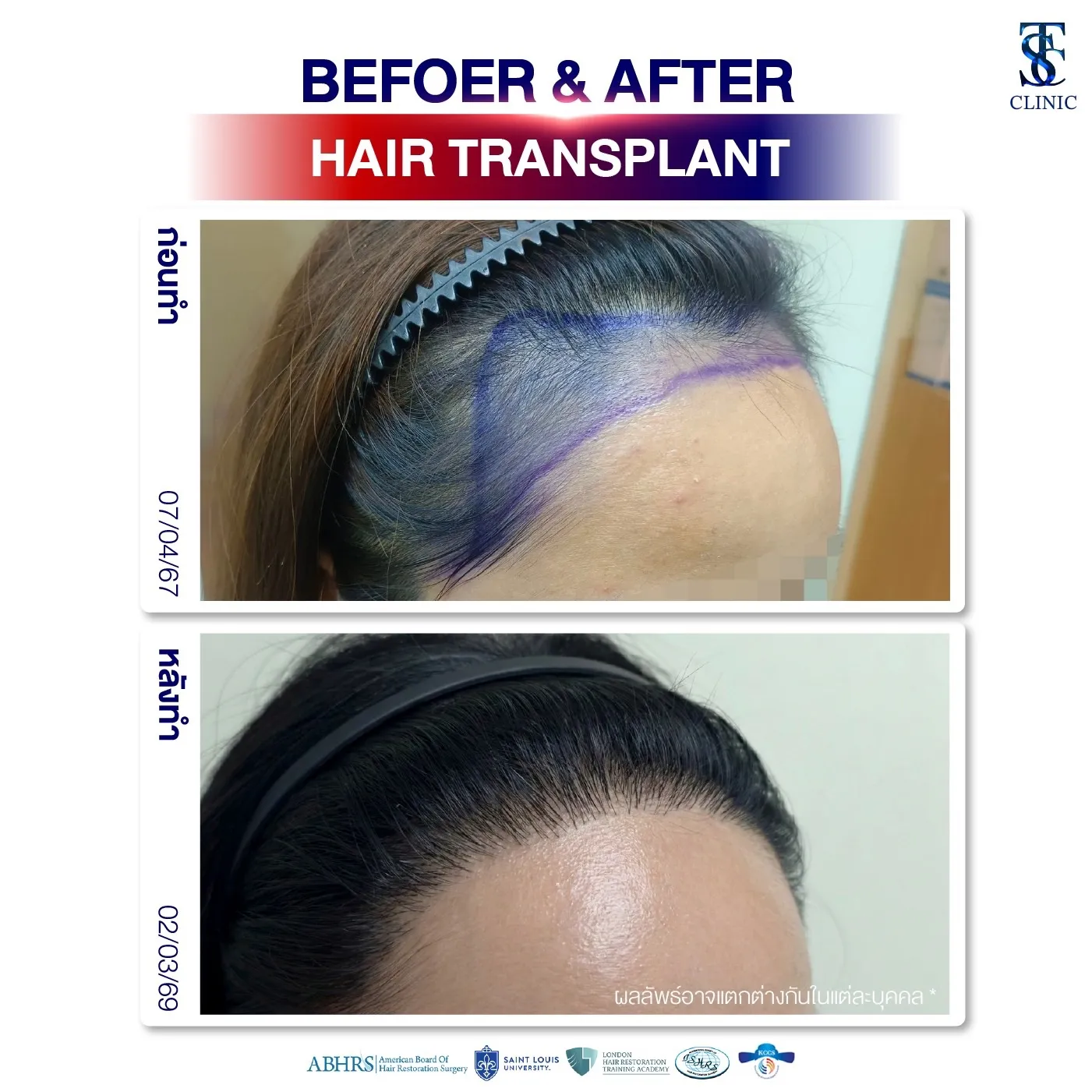 คลินิกปลูกผมถาวร ปลูกผม FUE ไร้รอยแผลเป็น | THE SKIN CLINIC