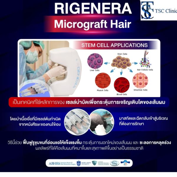 ทำไมต้อง "ปลูกผมระดับไมโครกราฟต์"?