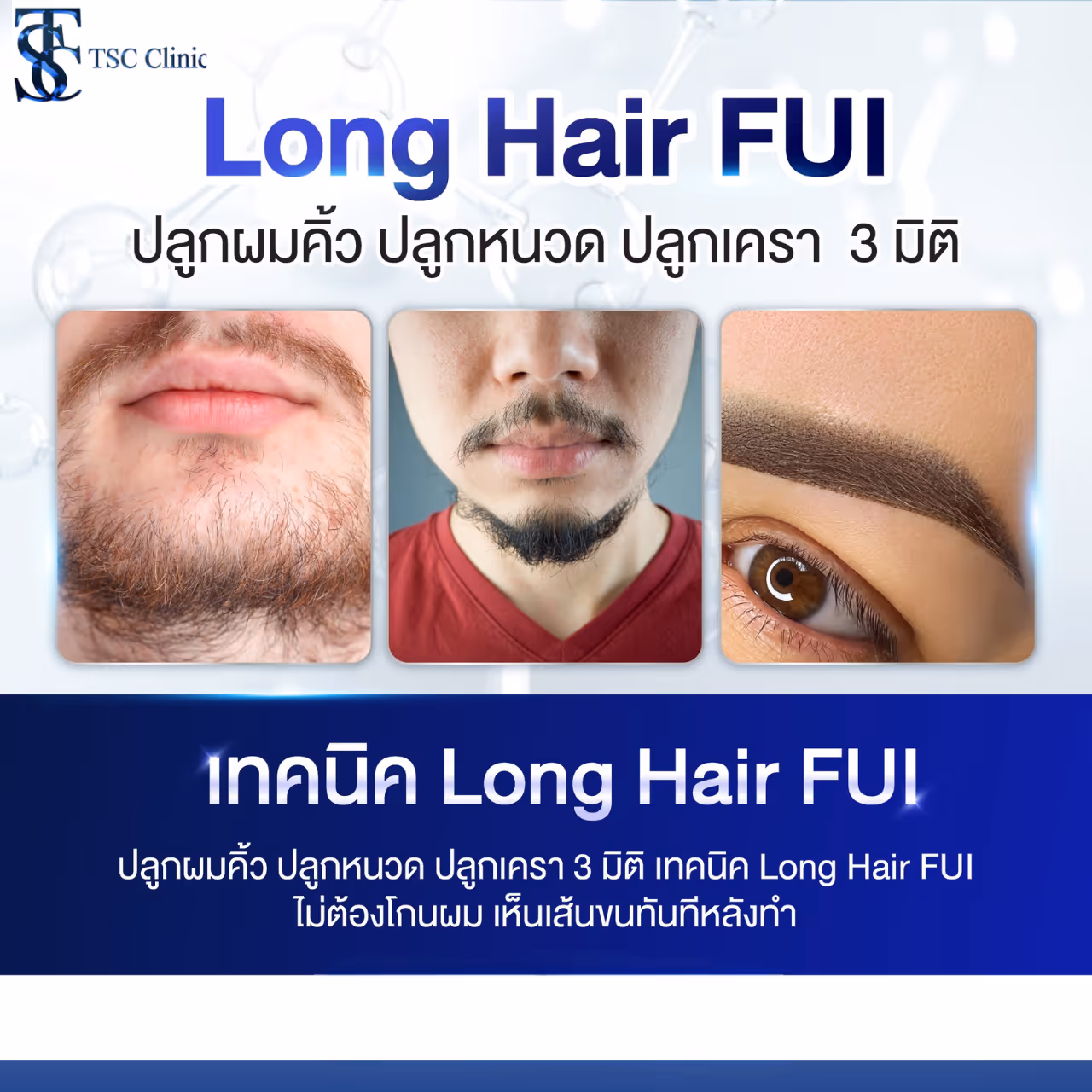 ปลูกคิ้ว ปลูกหนวด ปลูกเครา 3 มิติ | THE SKIN CLINIC