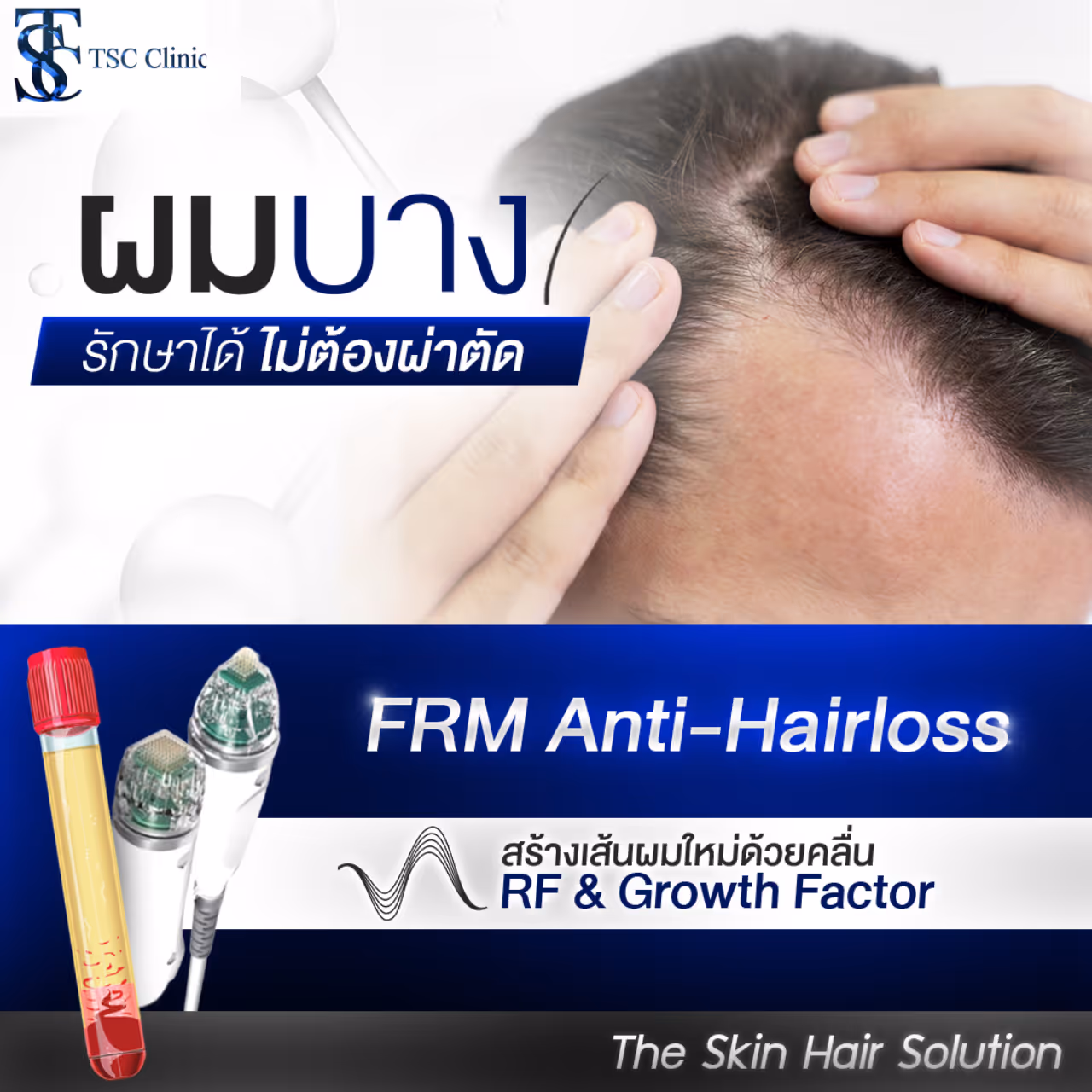 FRM Anti Hair Loss กระตุ้นรากผมด้วยคลื่นวิทยุ RF | THE SKIN CLINIC