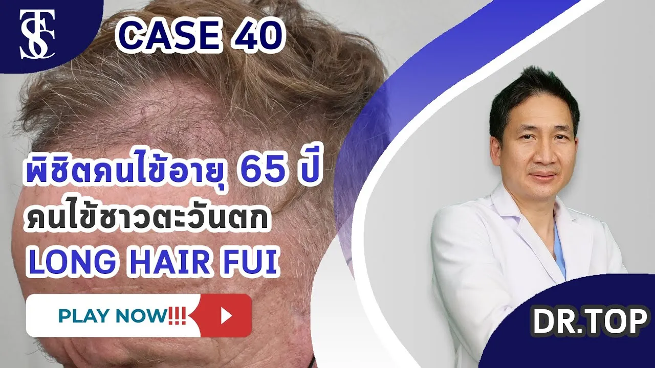 Patient 65 years old, treat the head in the frontal area.