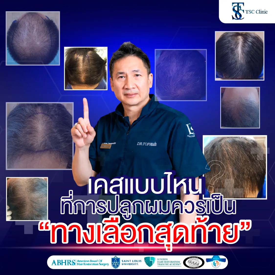 รักษาผมร่วง-ผมบางโดยไม่ต้องปลูกผม