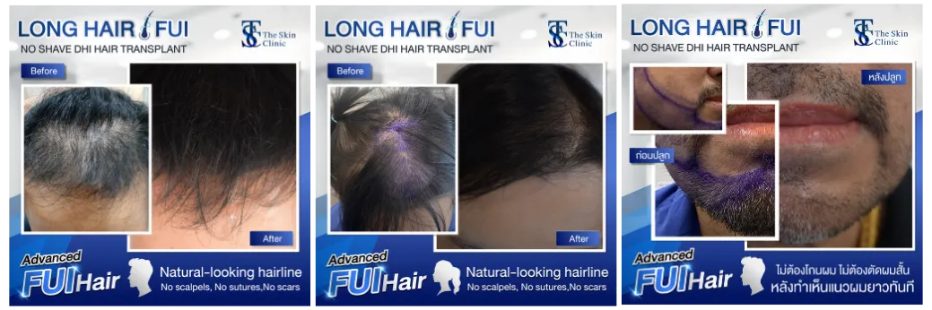 THE SKIN CLINIC | The result after hair transplant surgerywith the FUE (Follicular Unit Extraction) technique